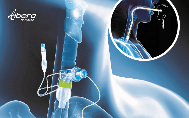 Implementación eficaz del SIMEX Cuff M en entornos hospitalarios