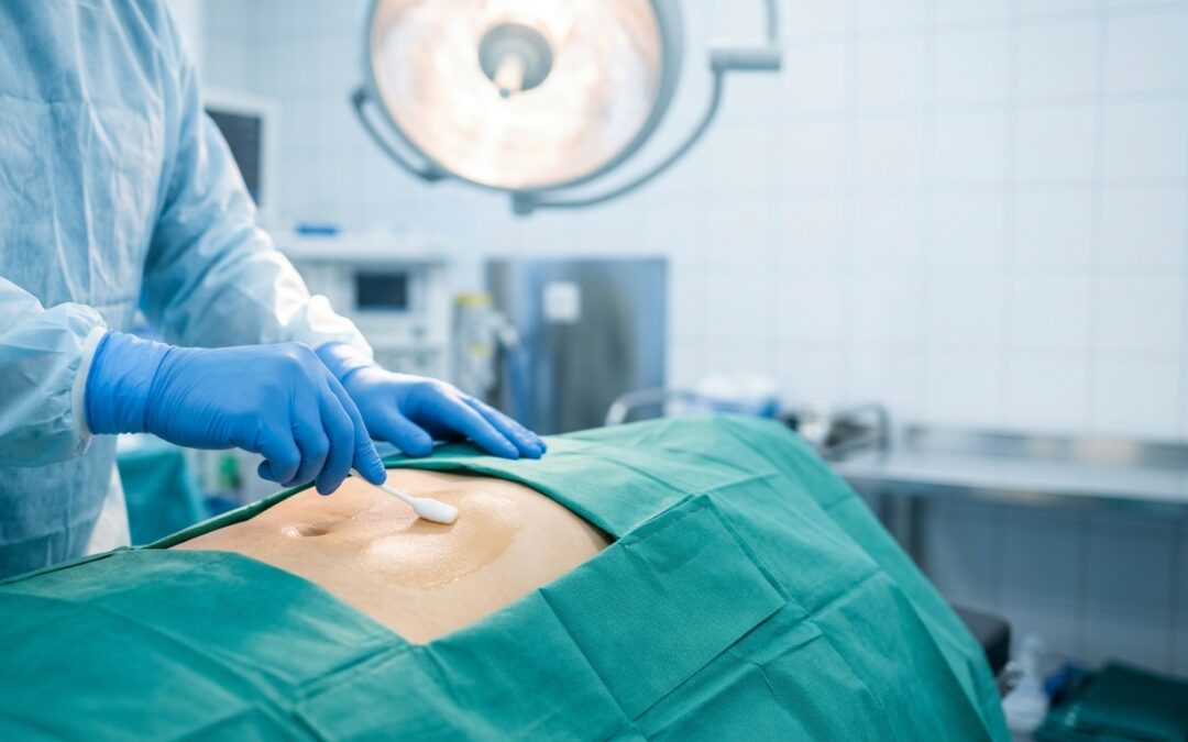 Antisepsia preoperatoria: la clave para prevenir infecciones de sitio quirúrgico
